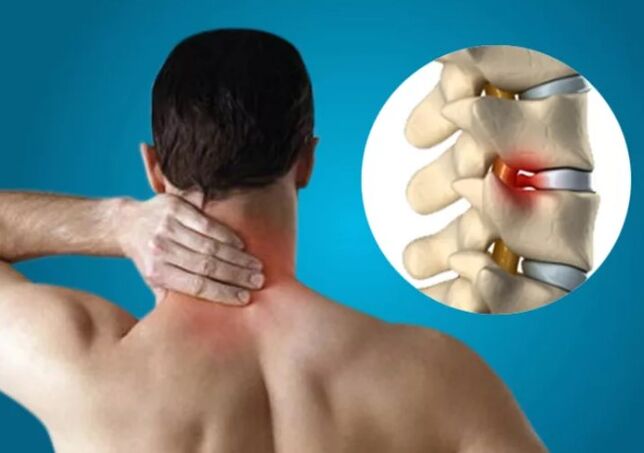 Cervikalna osteohondroza