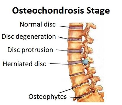 Faze osteohondroze