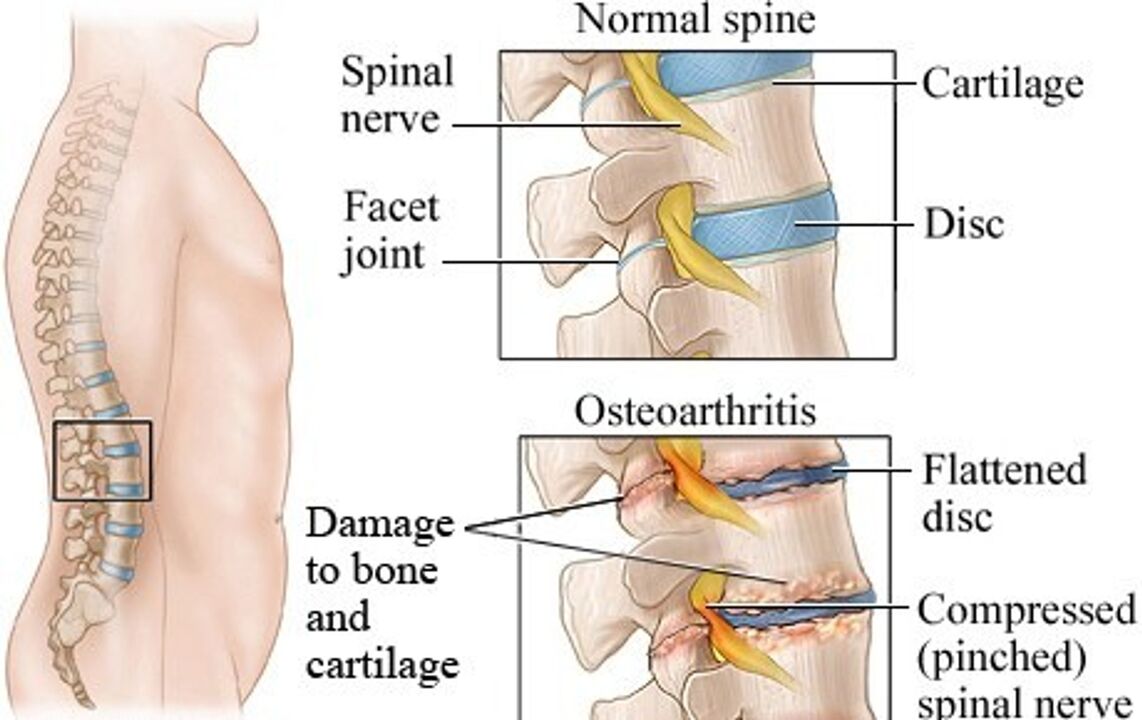 Razlika između zdravog diska i diska s osteohondrozom